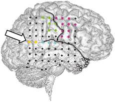 The Human Brain During OBE